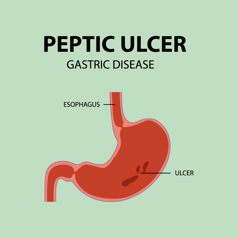 Detailed Illustration of Human Stomach Ulcers and Gastric Anatomy - Features Image 1