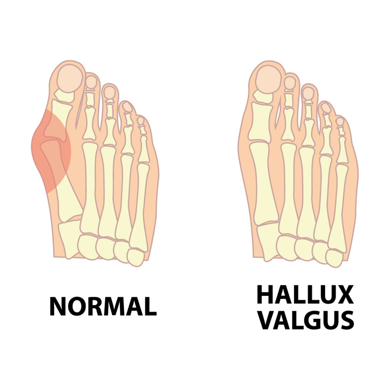 Normal Foot vs Hallux Valgus Anatomical Comparison - Features Image 1